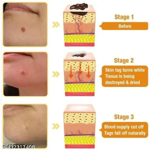 Skin Tag Remover Patch