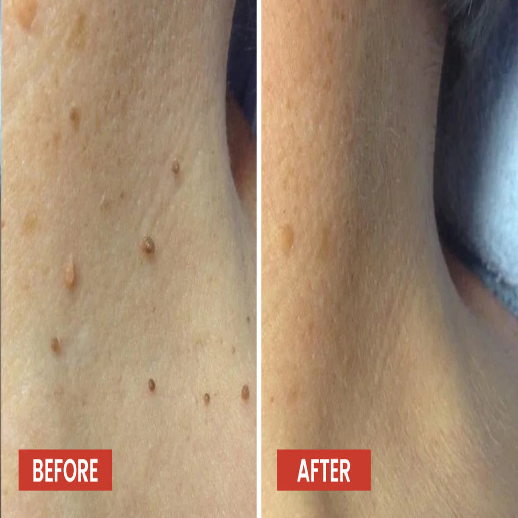 Skin Tag Remover Patch